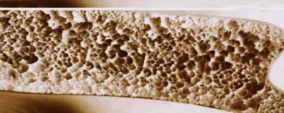 Baja densidad ósea osteopenia